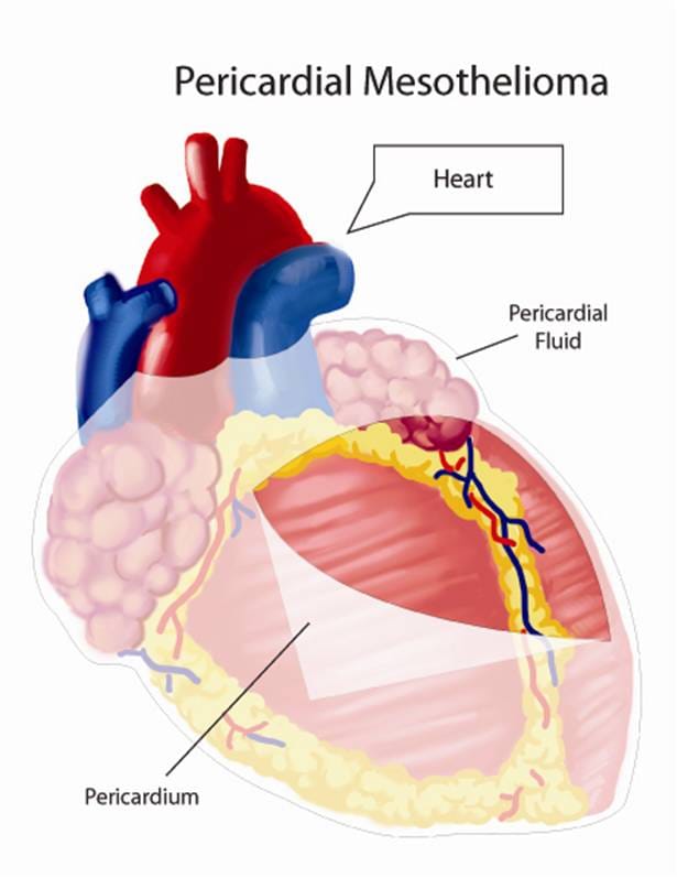 Diagram of Pericardial Mesothelioma affecting the heart