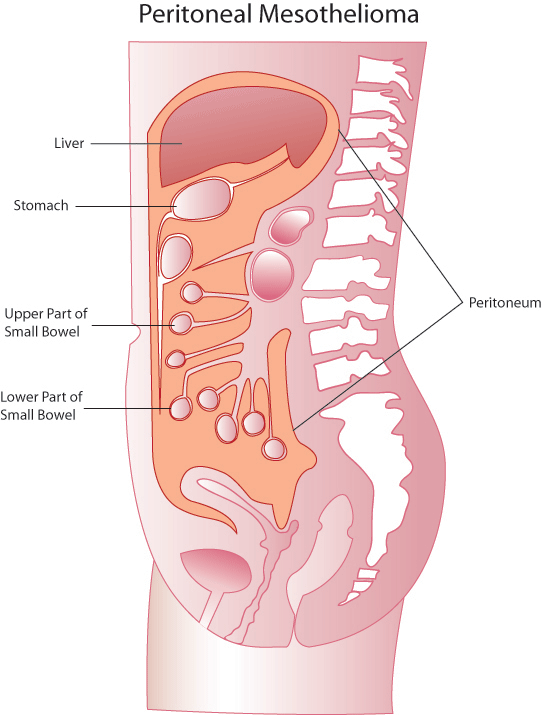 Diagram of Peritoneal Mesothelioma
